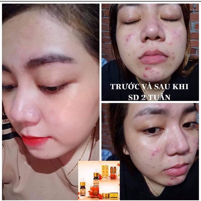 Serum mụn Collagen X3 Luxury mỹ phẩm Đông Anh Chính Hãng