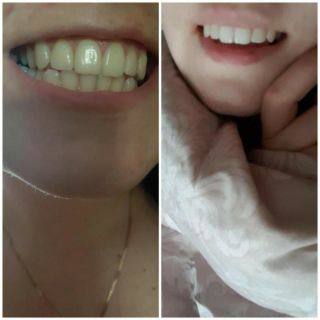 Kem đánh răng làm trắng than hoạt tính