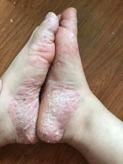Kem viên nấm cơ địa