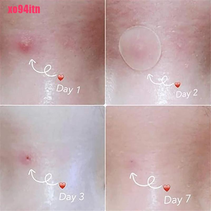 [Hàng mới về] Set 36 miếng dán hỗ trợ giảm mụn hydrocolloid hiệu quả