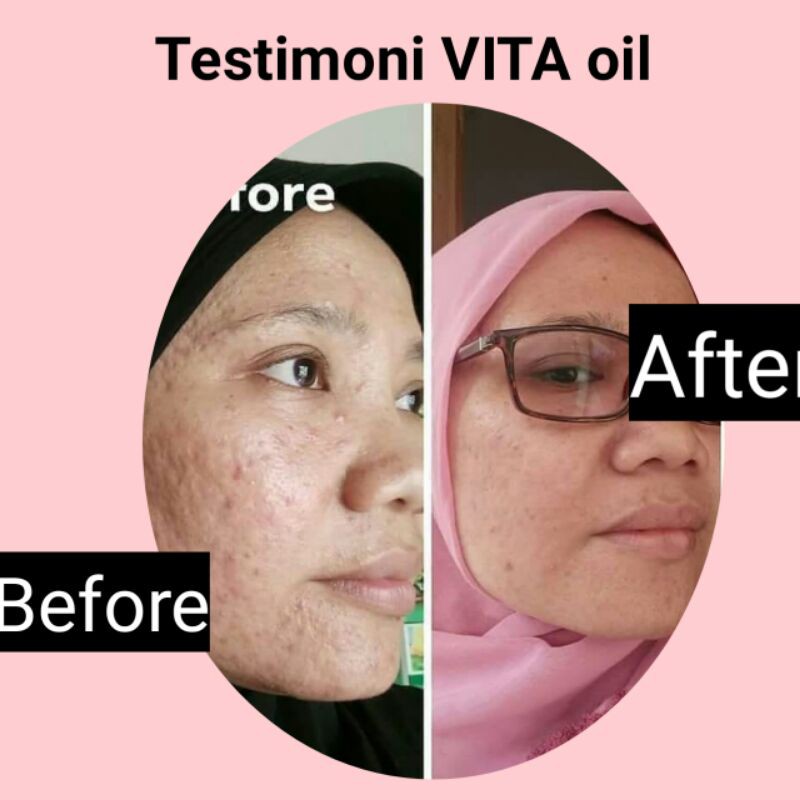 (hàng Mới Về) Kem Trị Sẹo Mụn Vitaoil Hiệu Quả