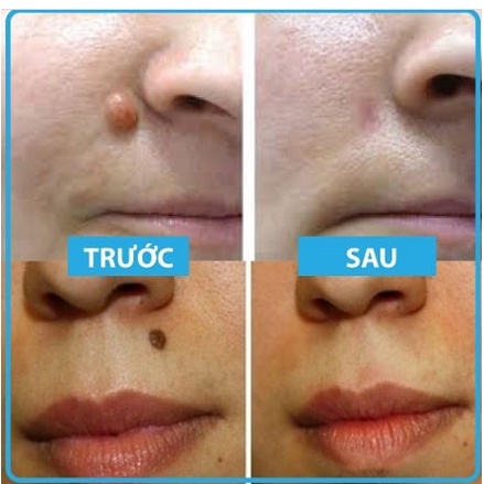 Tẩy Nốt  Ruồi, Gel Tẩy Nốt Ruồi Tàn Nhang, Mụn Cóc, Mụn Thịt, Mụn Cơm, Sẹo Lồi Develinil của Nga