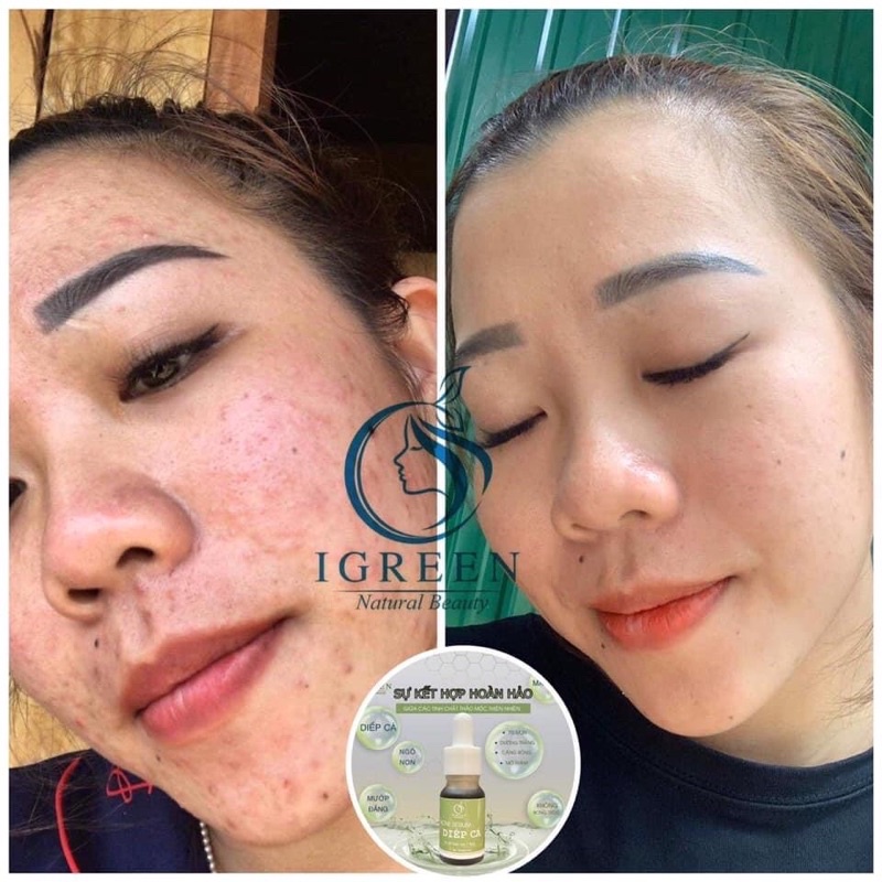 Serum Diếp Cá: - Sạch bay tất cả các loại mụn sau 7 ngày! - Sạch thâm, da sáng đều màu! - Kiềm dầu, se khít | BigBuy360 - bigbuy360.vn