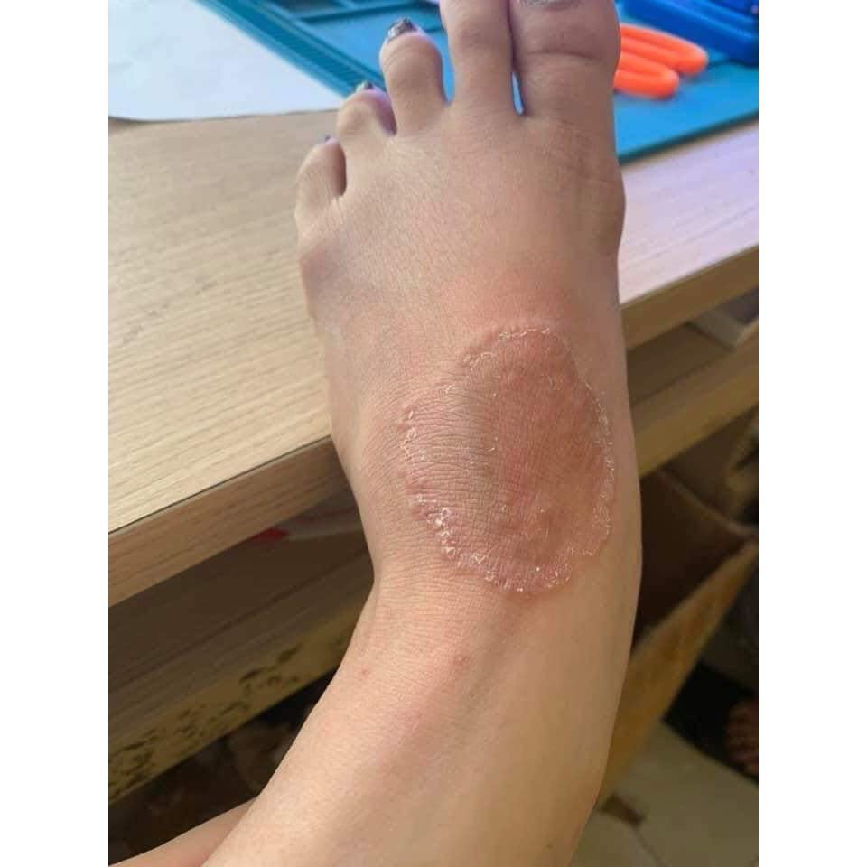 Kem Bôi Nấm Ngứa, Hắc Lào, Lang Ben, Vảy Nến, Á Sừng, Viêm Da Các Vấn Đề Da Liễu Lâu Năm (XD) | BigBuy360 - bigbuy360.vn