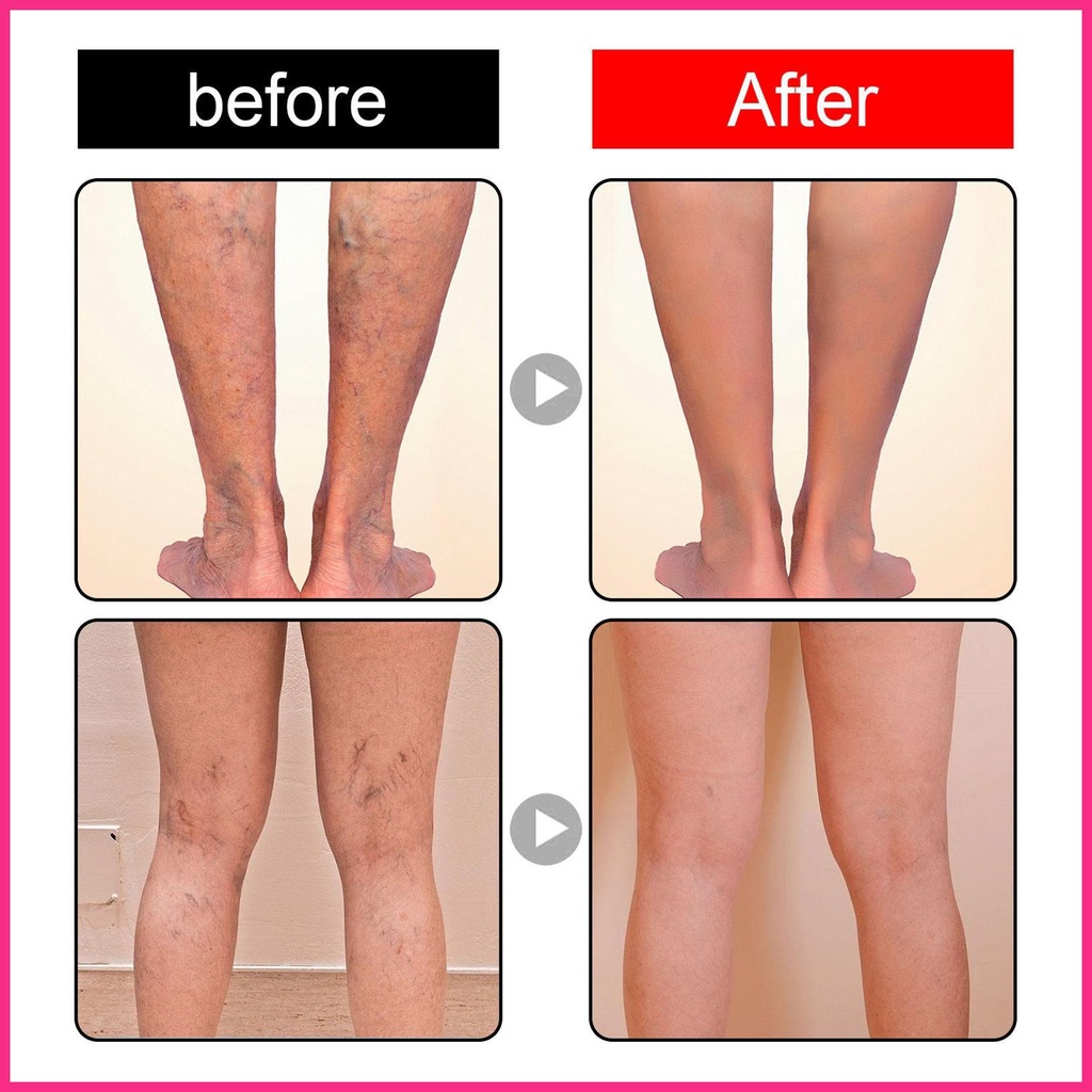 Bộ 12 Miếng Dán Trị Giãn Tĩnh Mạch Cao Cấp Chuyên Dụng