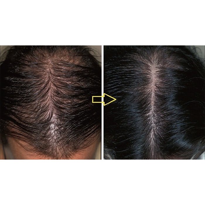 Thuốc mọc tóc Kaminomoto General Hair Growth