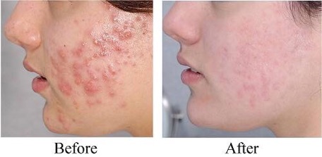 [Chọn size] Kem trị mụn pair Nhật Bản