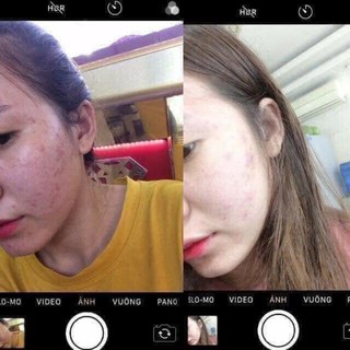 SERUM CHẤM MỤN 12H HUỲNH ĐỖ