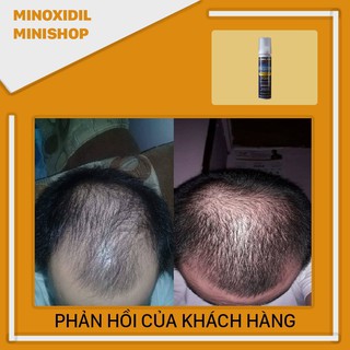 Minoxidil 5% Dạng Bọt Mọc Râu Tóc Kirkland Mỹ