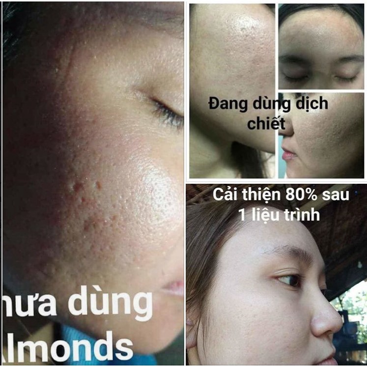 Cao Cấp Bộ Sản Phẩm Làm Đầy Sẹo Rỗ BLURRING SCARS ..
