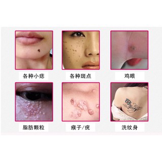 Máy xóa nốt ruồi tàn nhang
