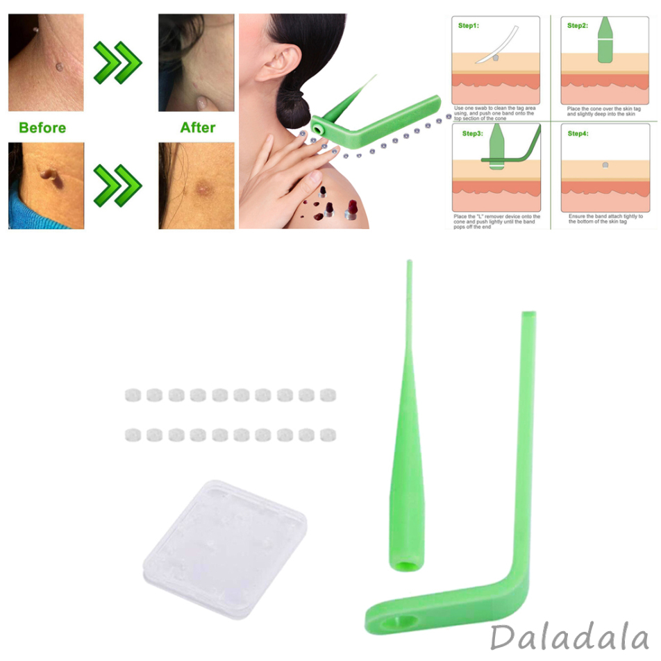 Micro Skin Tag Removal Device Kit for Small to Medium Skin Tags for Men Women, Green