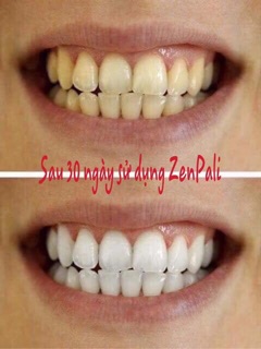 Bột trắng răng Zenpali