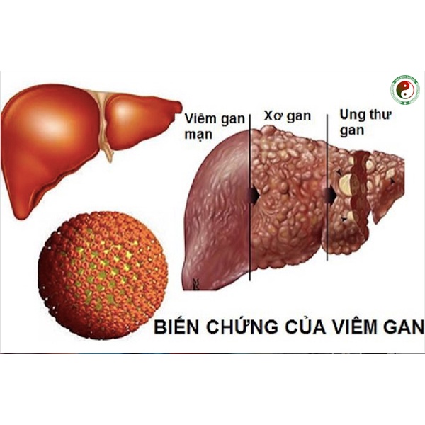 Giải Độc Gan Hạ Men Gan - Giải Độc Cơ Thể - Thải Độc Gan Nhiễm Mỡ