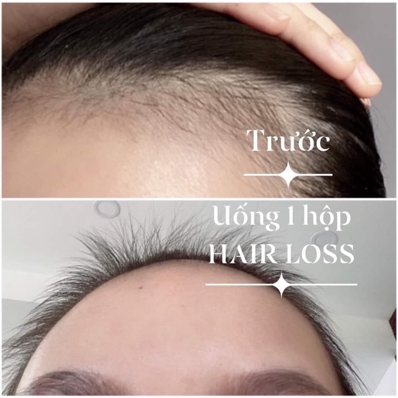Viên Uống Mọc Tóc. Ngăn Ngừa Rụng Tóc Kích Thích Mọc Tóc Nhật Kim Anh