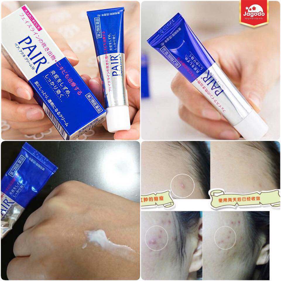 Kem giảm mụn Pair 24g Nhật hỗ trợ giảm mụn ngăn ngừa mụn chấm mụn cóc đầu đen thâm ẩn hoa đào của nhật Queen Beauty | WebRaoVat - webraovat.net.vn