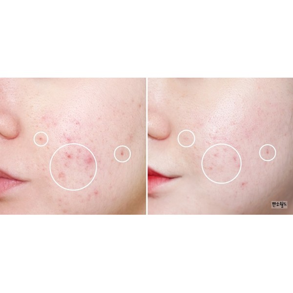 Gel giúp giảm mụn, làm dịu da kích ứng Bija Cica Balm. | BigBuy360 - bigbuy360.vn