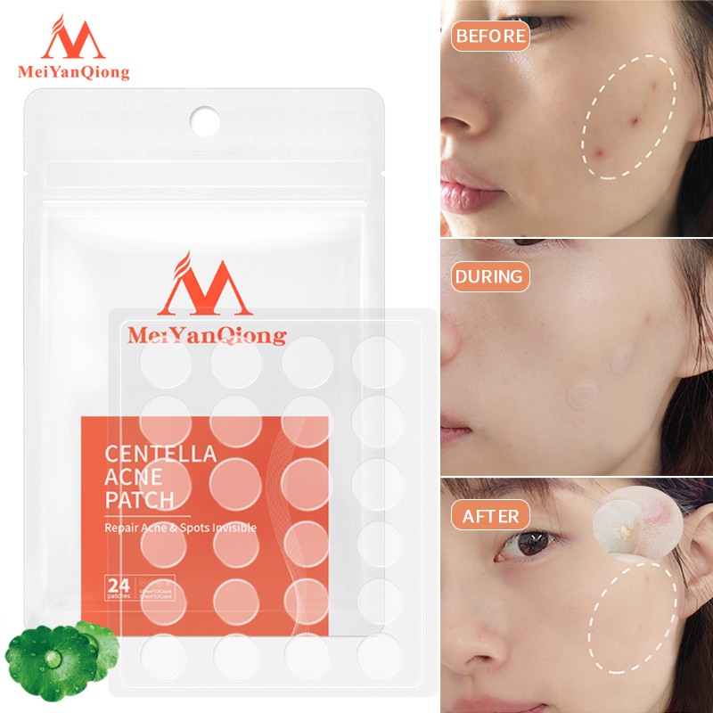 MeiYanQiong Miếng dán lột mụn giảm mụn đầu đen Phục Hồi àm làm  sạch sâu Da cho vùng mũi 24 viên