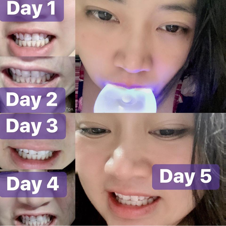 [ Úc hàng có sẳn] Máy làm trắng răng bằng ánh sáng xanh White Glo White Accelerator Blue Light Teeth Whitening System