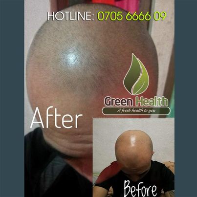 Dung dịch mọc râu tóc Minoxidil 10% Tugain