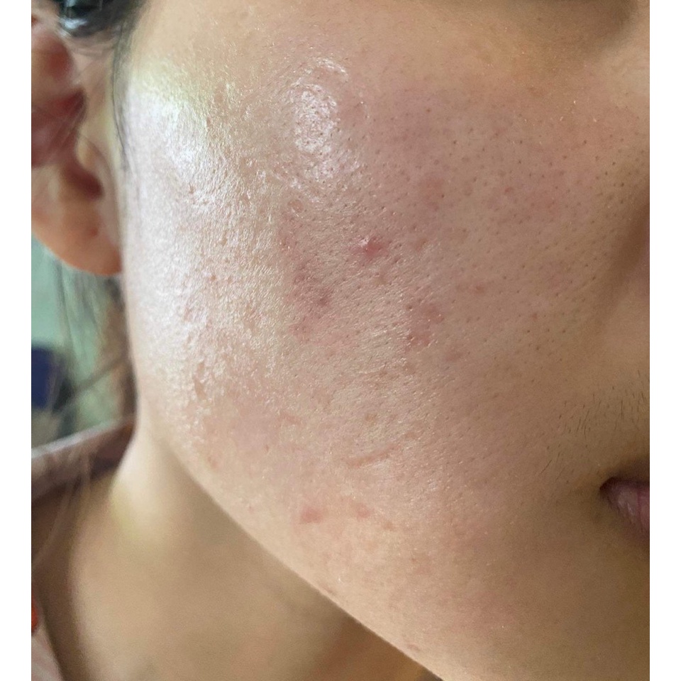 Tinh Chất Tái Sinh Da CENNATURALGiam Mụn Thâm Nám Lô Chân Lông To Sẹo Lõm