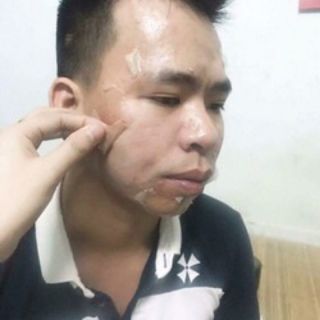 Piu Da Xóa Nám Sạm