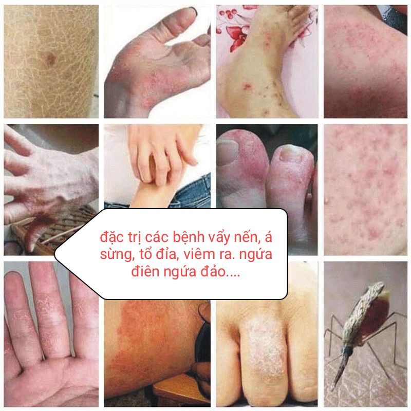 Kem bôi ngoài da,bôi nấm ngứa,vảy nến, á sừng, tổ đỉa, nấm tay, nấm chân, hiệu quả