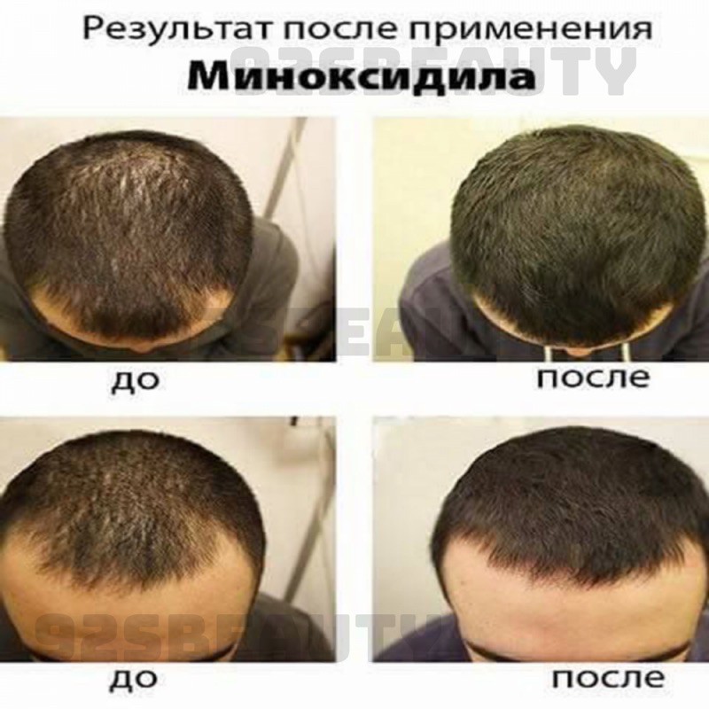 Serum kích thích mọc tóc, ngăn ngừa rụng tóc Compliment Se Selen+ | BigBuy360 - bigbuy360.vn