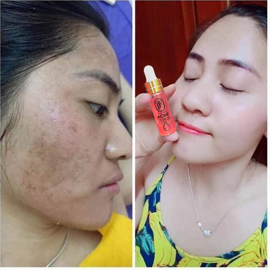 [Chính hãng] Serum truyền trắng, tri mun TP Cosmetics - Dưỡng da trắng khỏe, mun không tái phát, phù hợp với da nhạy cảm | BigBuy360 - bigbuy360.vn