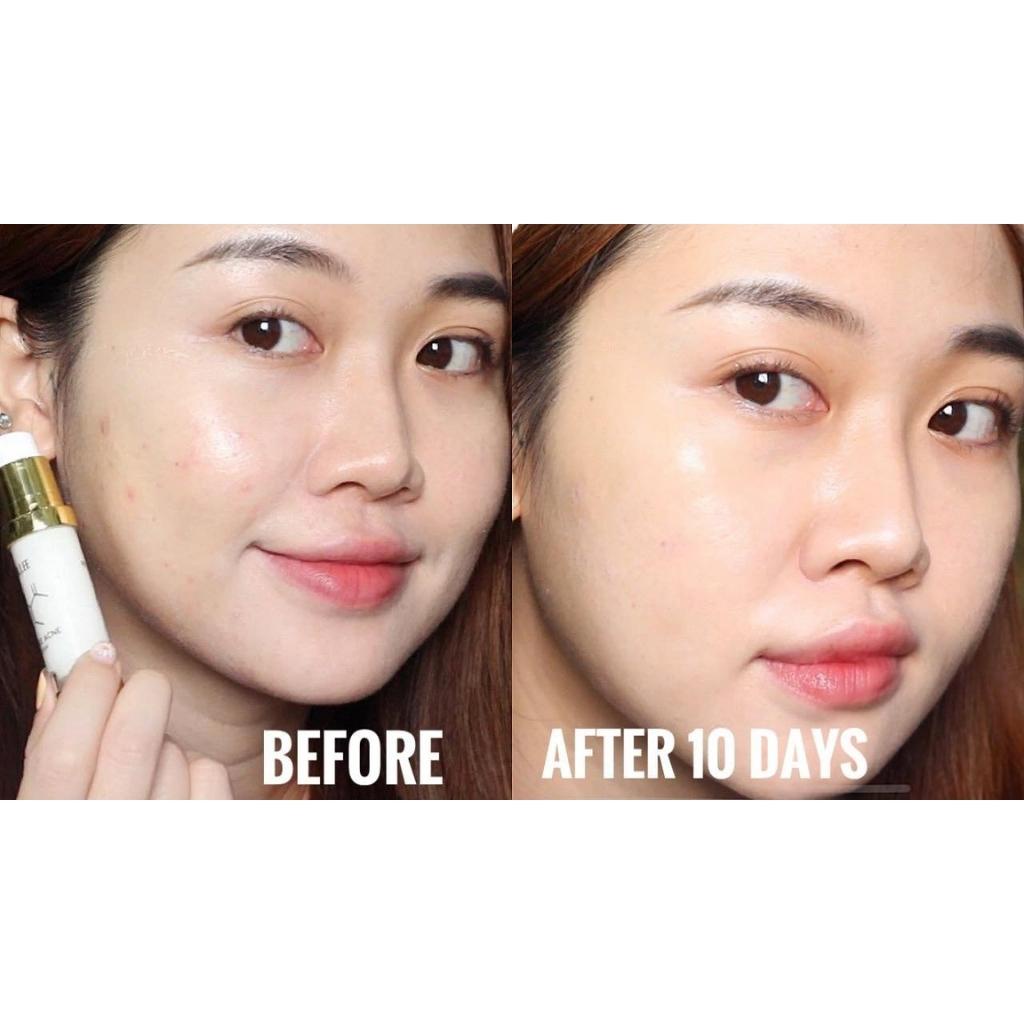 Kem Giảm Mụn, làm khô đầu mụn và đẩy nhân mụn, giúp giảm thâm mụn Dr. Lee Reduce Acne Cream 10g-Hàng Chính Hãng