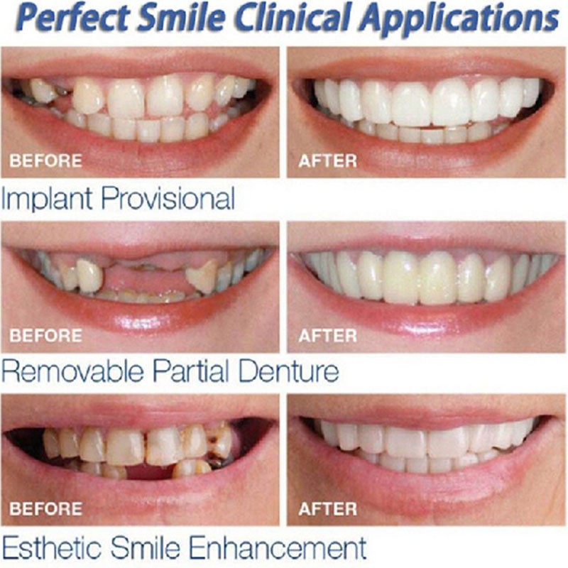 Sẵn sàng chuyển hàng Hot 2Pcs Perfect Smile Răng giả Che răng giả Răng giả Veneers Trắng răng trắng Răng chụp lại răng Chăm sóc răng giả thẩm mỹ