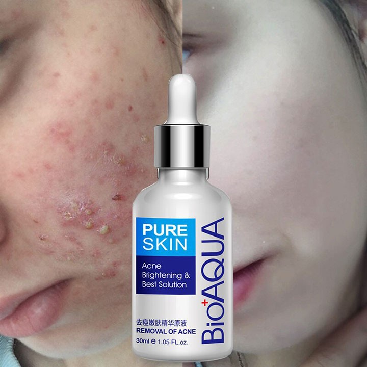 Serum Bioaqua Chuyên Ngừa Mụn BQY0726
