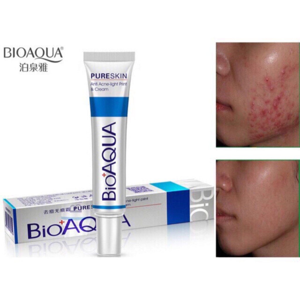 Kem Làm Sạch Mụn Trứng Cá Pure Skin Bioaqua - Giải Quyết các vấn đề về Mụn Bọc, Mụn Thâm