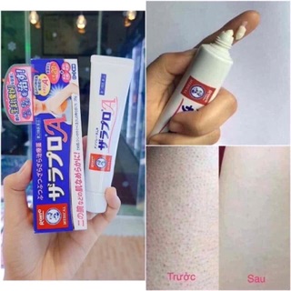 Trị viêm chân lông Nhật Bản