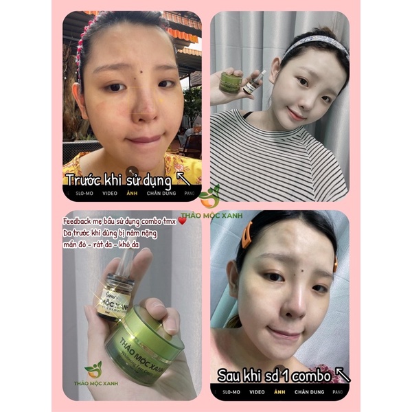 Combo trắng da ( serum tmx x5 &amp; kem face )
