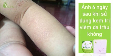 KEM TRỊ VIÊM DA TRẦU KHÔNG SUE’N