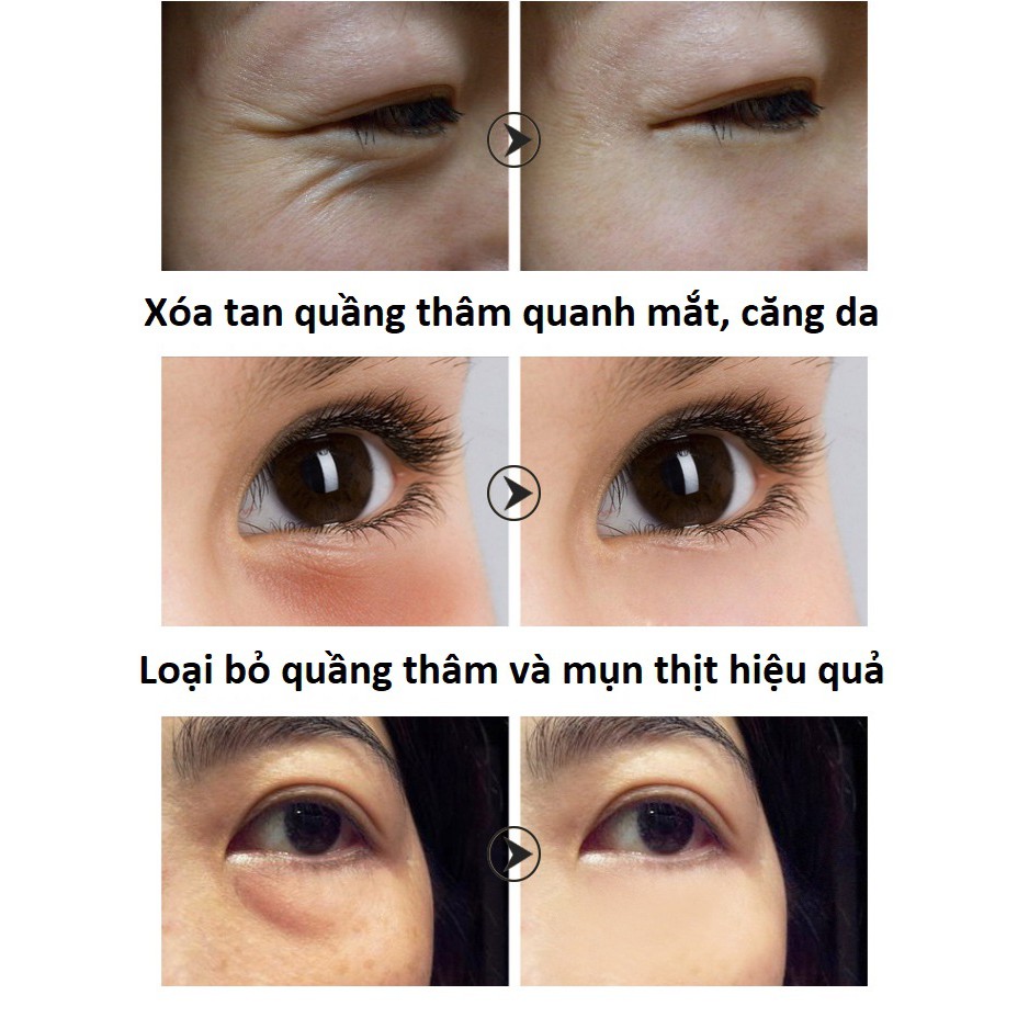 Kem Xóa Quầng Thâm, Tan Bọng Mắt, Giảm Mụn Thịt | BigBuy360 - bigbuy360.vn