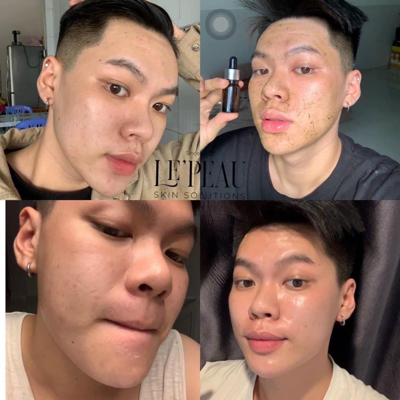 Peel mờ Thâm Mụn, Nám, Tàn Nhang, Sáng da - Tặng Serum B5 phục hồi da -  Peel da Vi Tảo Retinol - LE’PEAU