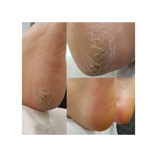 Dụng Cụ Chà, Dũa Gót Chân tiện dụng