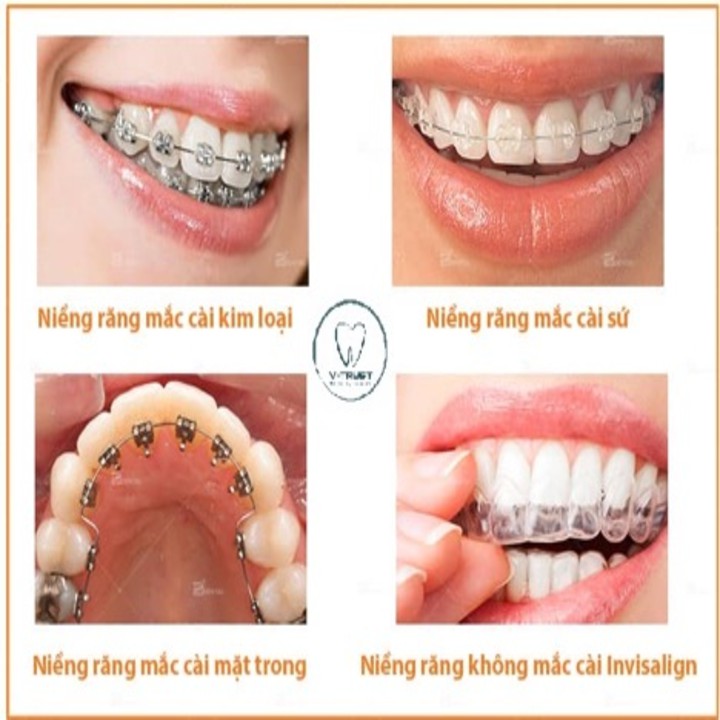 Bộ Dụng Cụ Niềng răng Trainer -  Niềng Răng Tại Nhà - Niềng răng trong suốt ( 3 giai đoạn ) hàng chất lượng