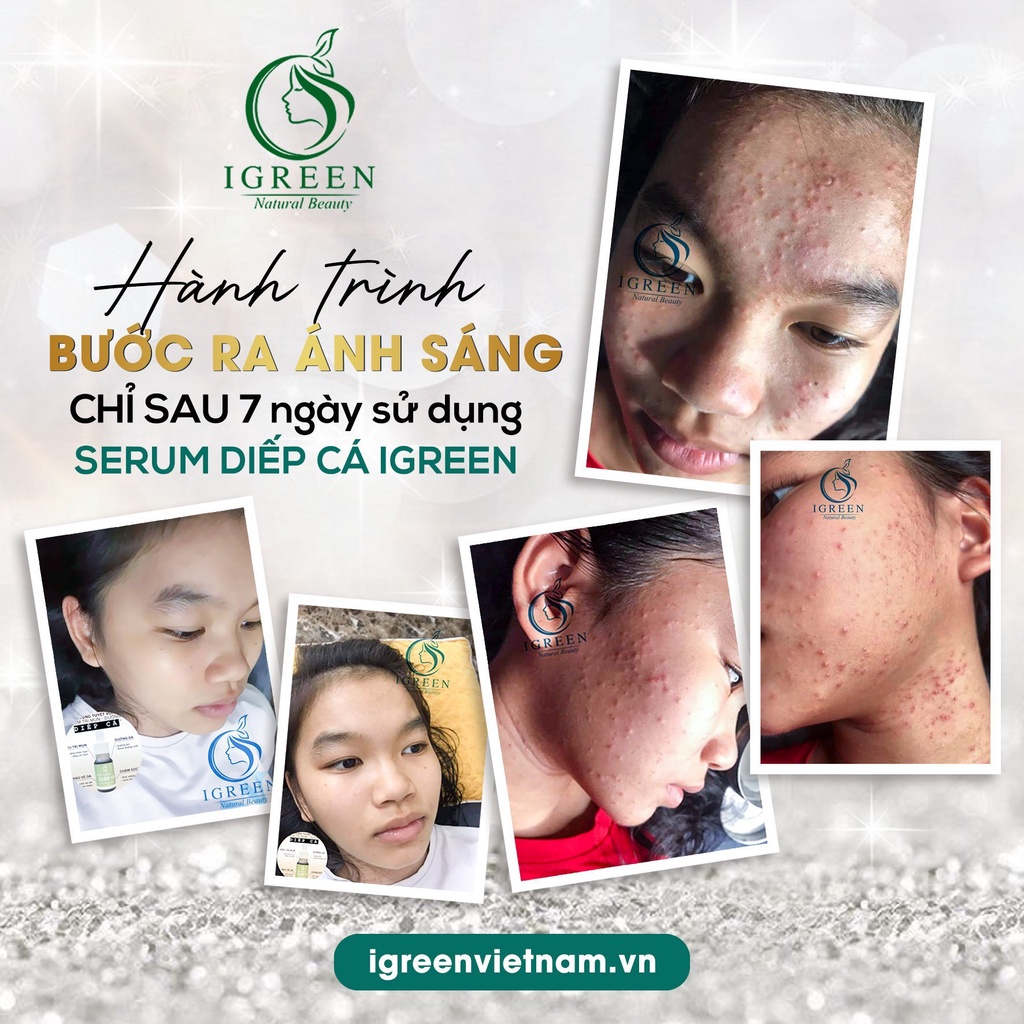 Serum diếp cá, serum diếp cá Igreen 10ml sạch mụn thâm se khít lỗ chân lông, dưỡng da căng bóng mịn màng | BigBuy360 - bigbuy360.vn