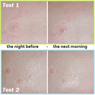 Hộp Dán Mụn Missha Speedy Solution Trouble Patch Set