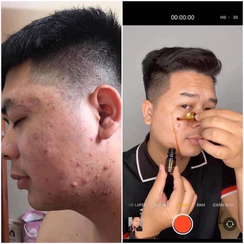 Serum ngừa mụn không sưng cốt rượu sake Sake Acnes Liquid Magic Skin