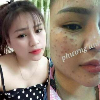 CHẤM TÀN NHANG PHƯƠNG ANH