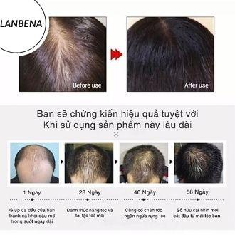 Tinh Chất Kích Thích Mọc Tóc, Dưỡng Tóc Chuyên Sâu, Ngăn Ngừa Gãy Rụng, Đẩy Nhanh Quá Trình Mọc Tóc