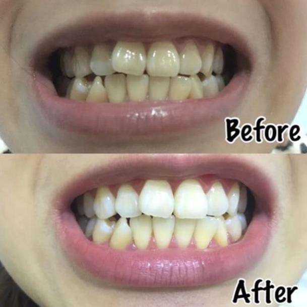 445566 Combo 14 miếng (7 gói/7 ngày) dán trắng răng Crest 3D White Whitestrips loại Professional Effects - Mỹ bopster