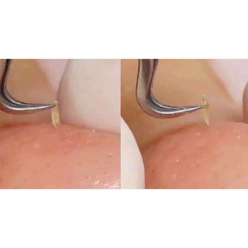 Nhíp Gắp Mụn Vacosi giúp lấy nhân mụn dễ dàng an toàn vệ sinh