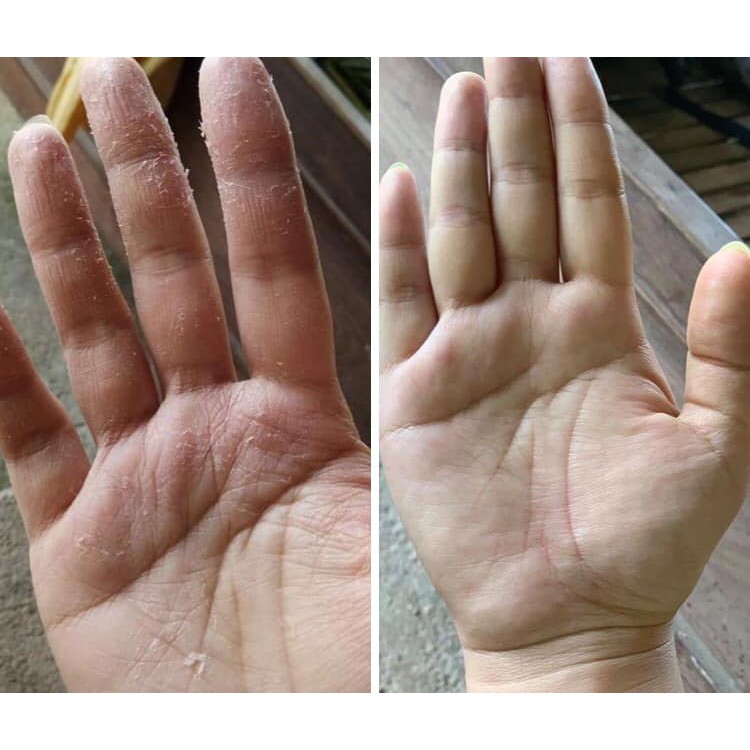 Thảo Mộc Lợi An - Thuo.c Tri Nấm Ngứa, Nấm Móng, Nấm Da Đầu, Vảy Nến, Á Sừng, Viem Da, Viem Da Cơ Địa, Viêm Lỗ Chân Lông | BigBuy360 - bigbuy360.vn