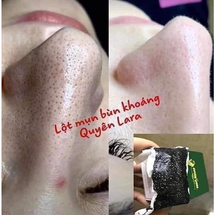 Gel Lột Mụn Đầu Đen Bùn Khoáng Quyên Lara,Lột Sạch Mụn Cám,Đầu Đen Ngay Sau Lần Sử Dụng Đầu Tiên 50g