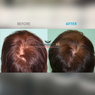 Thuốc mọc tóc Minoxidil 5% cho Nữ